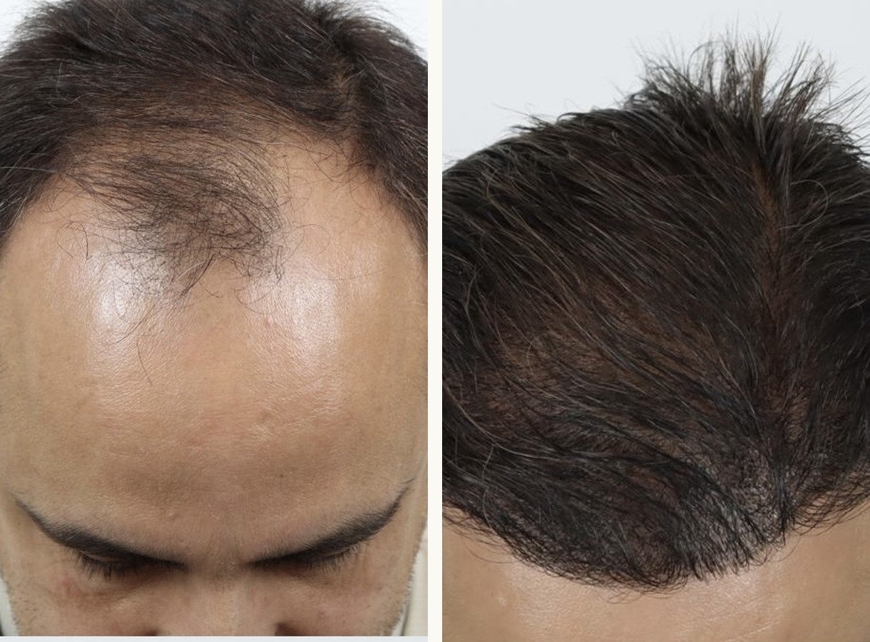 Crown and mid-scalp hair transplant before and after — Top-down view
