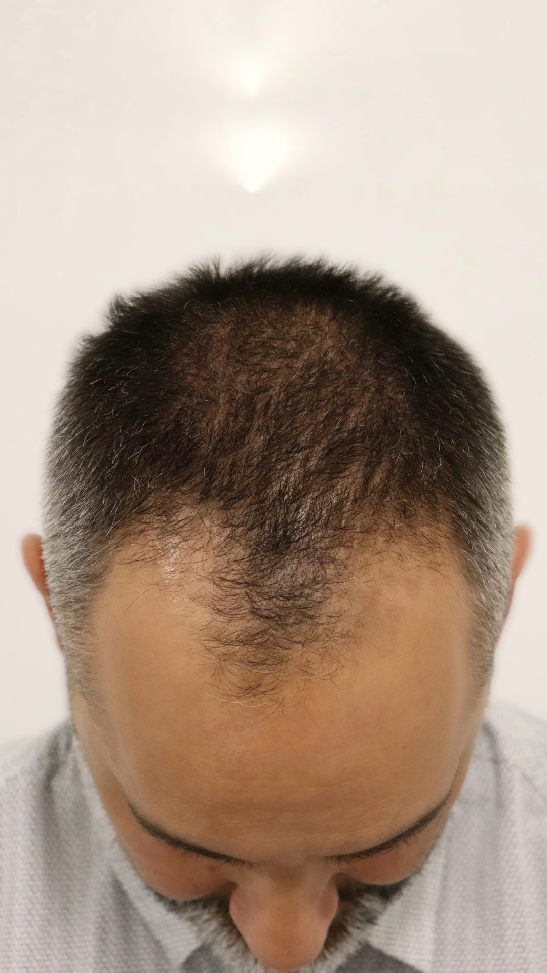 Overhead view of thinning hair and a receding hairline before the transplant