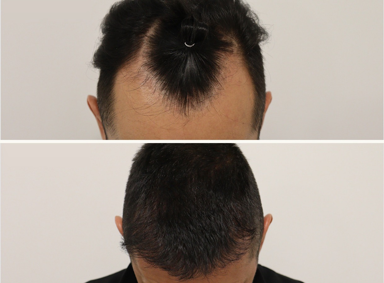 Crown and mid-scalp hair transplant before and after — Top-down view