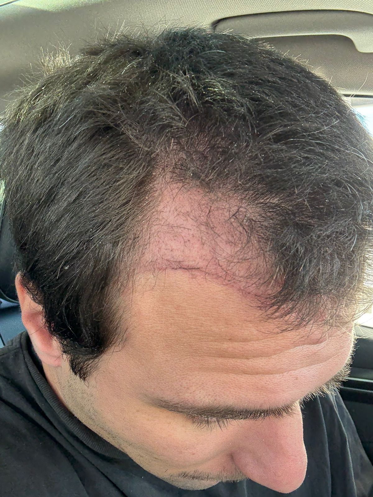 Close-up of a freshly transplanted hairline on the day of the procedure