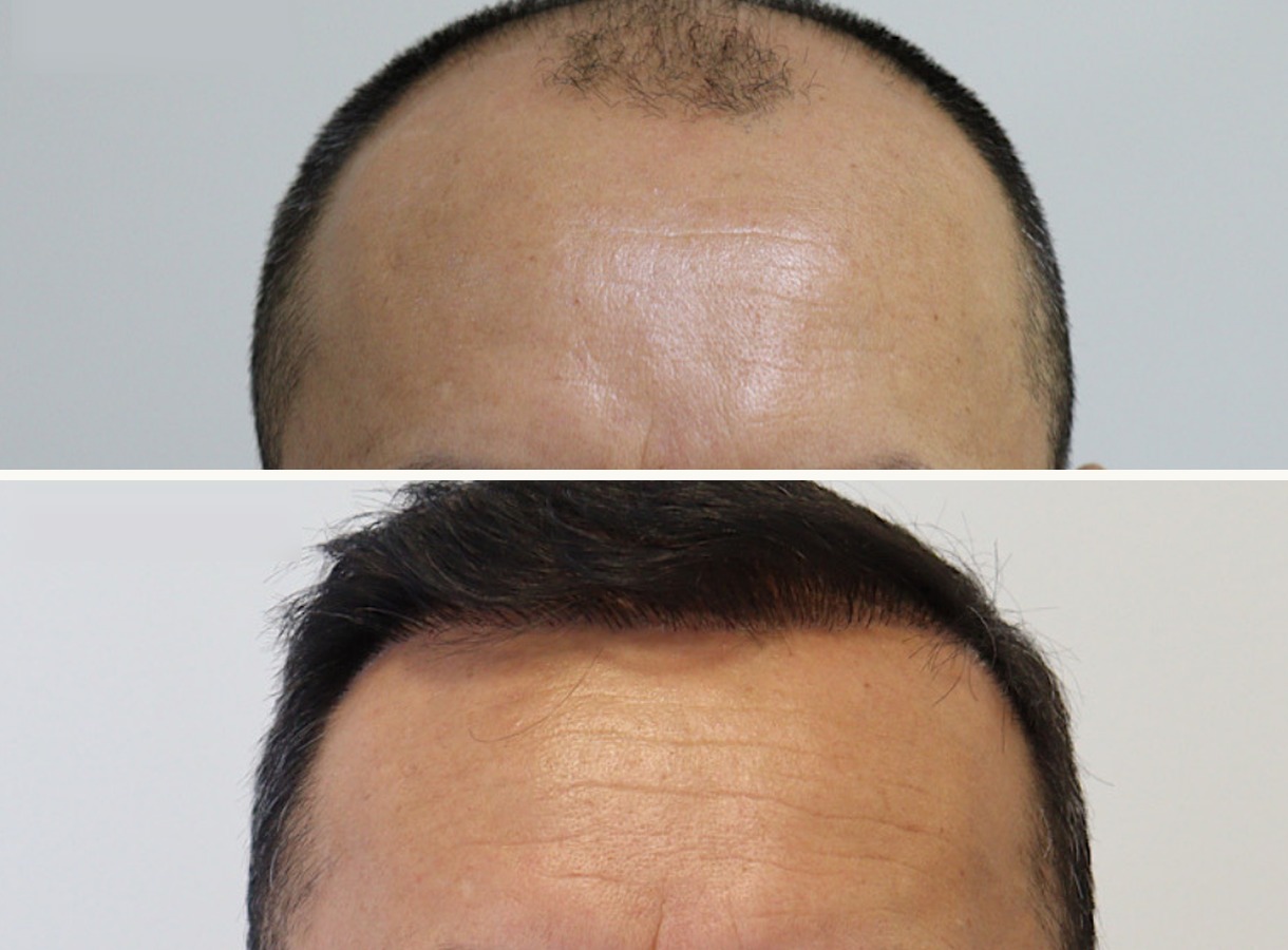 Hairline restoration hair transplant before and after — Top-down view