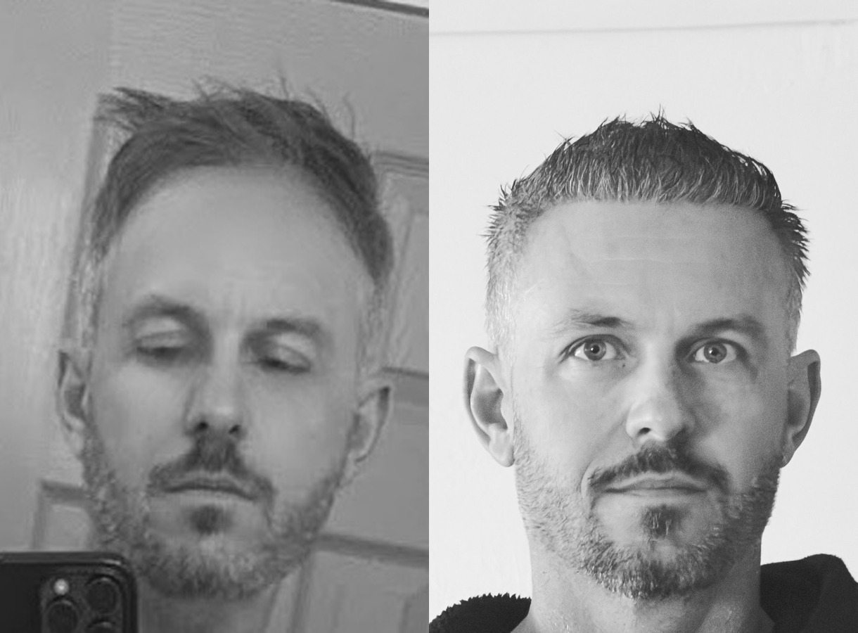 Hairline restoration hair transplant before and after — Front view
