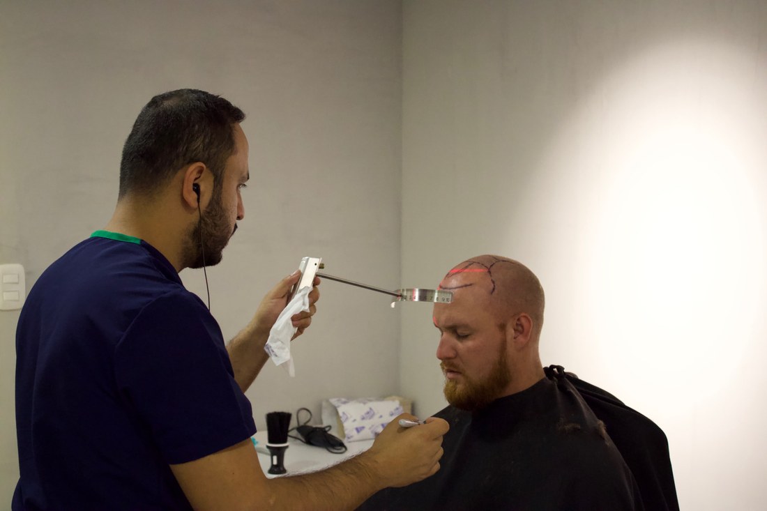 Encore surgeon measuring a patient's hairline with precision instruments before drawing