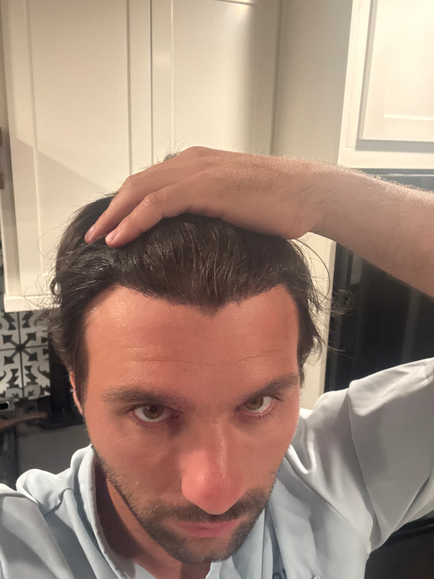 Healed, dense hairline result eight months after the transplant procedure