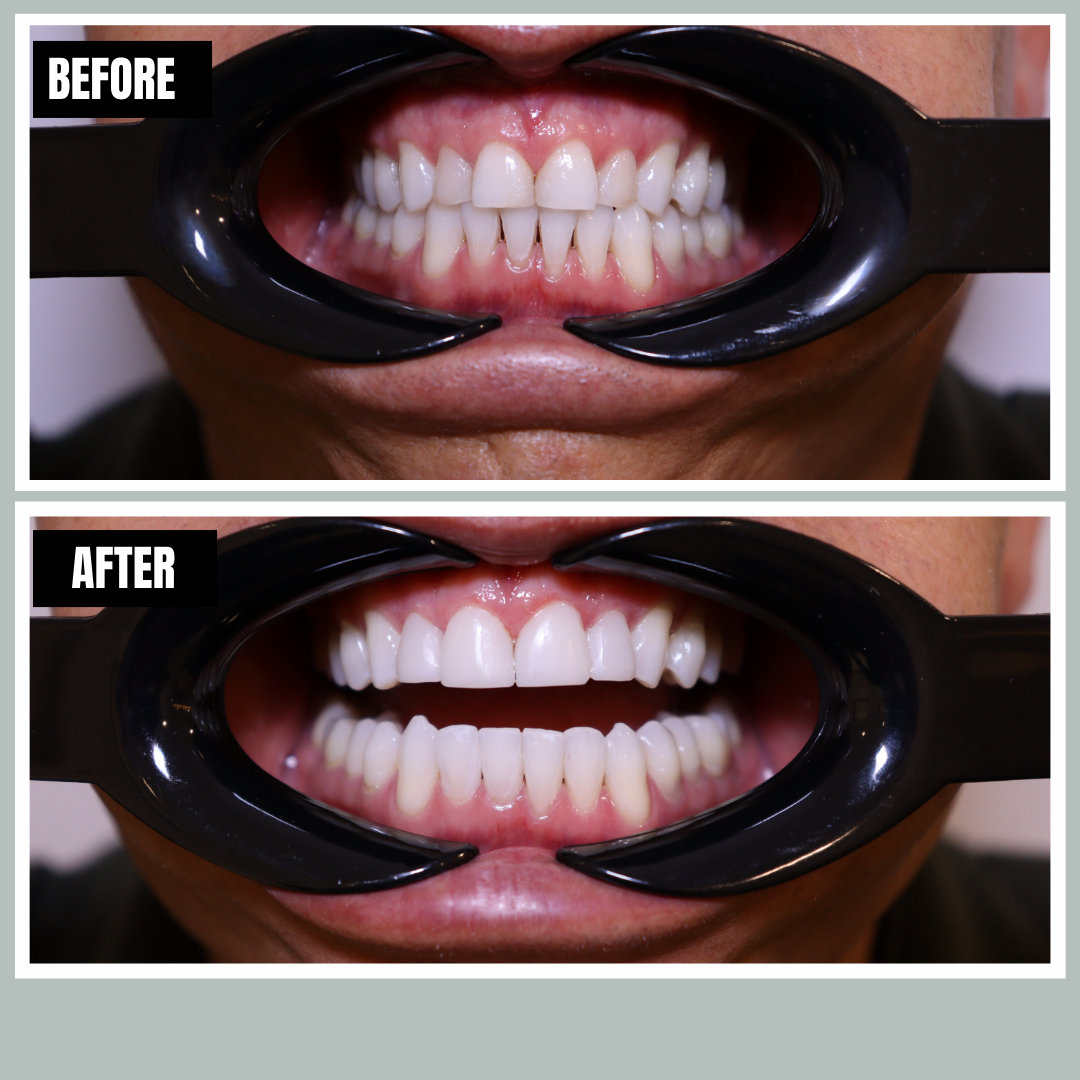 Veneers before and after, Encore Bogotá patient