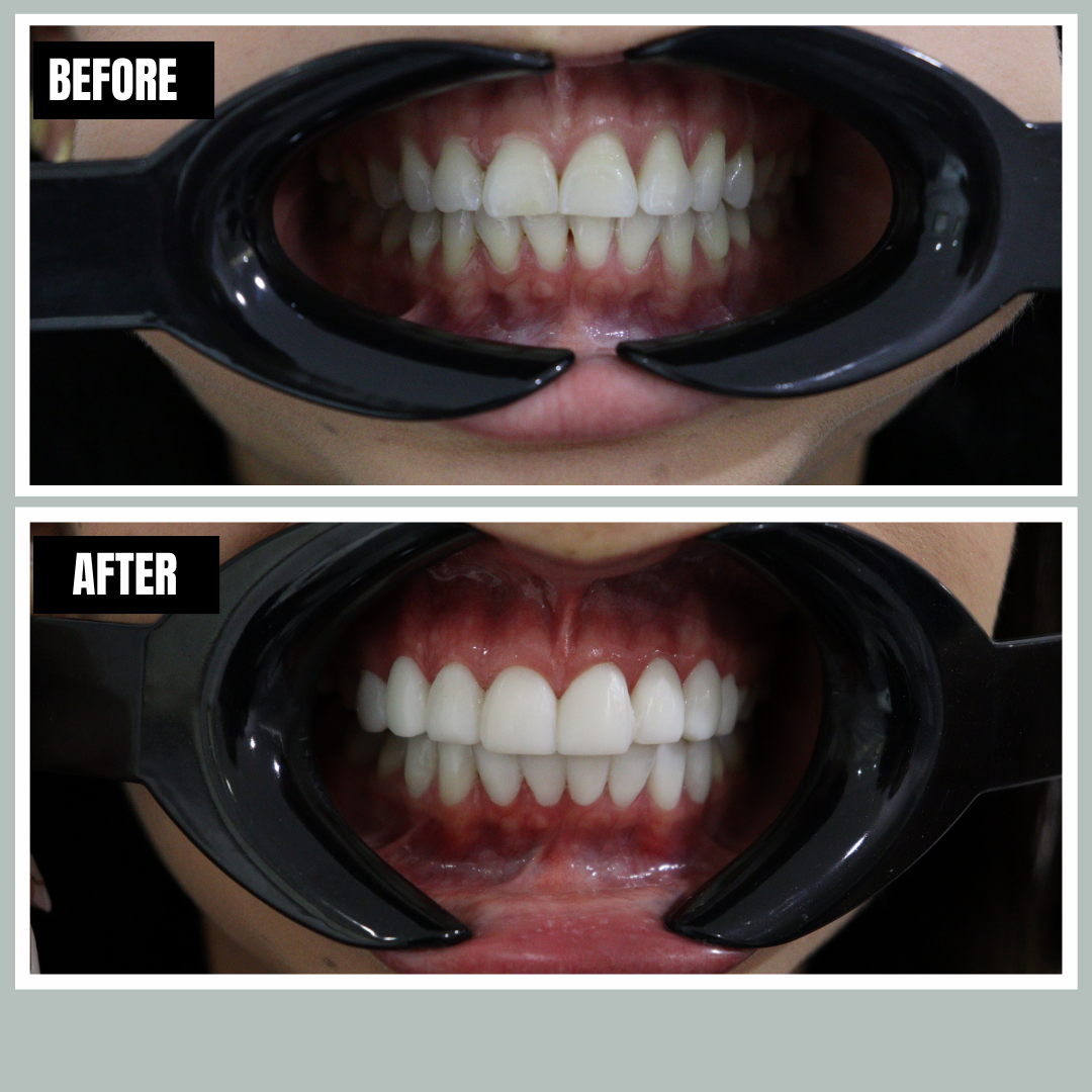 Veneers before and after, Encore Bogotá patient
