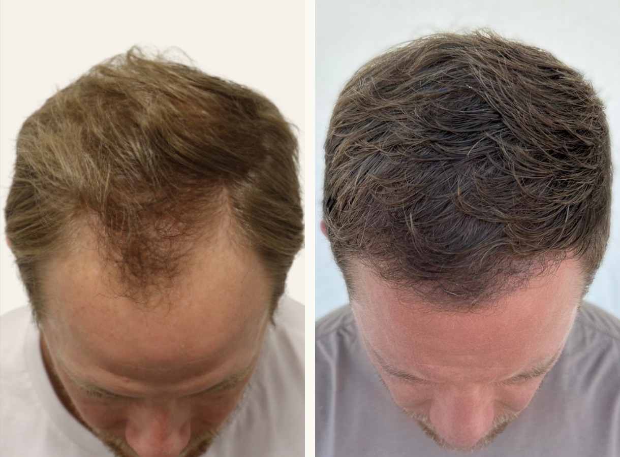 Hairline restoration hair transplant before and after — Front view