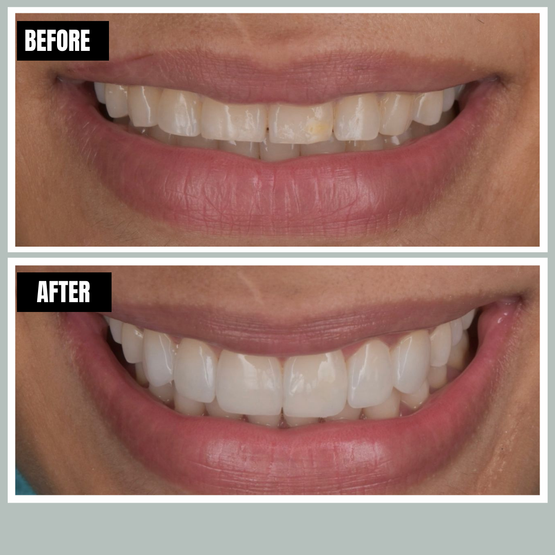 Veneers before and after, Encore Bogotá patient