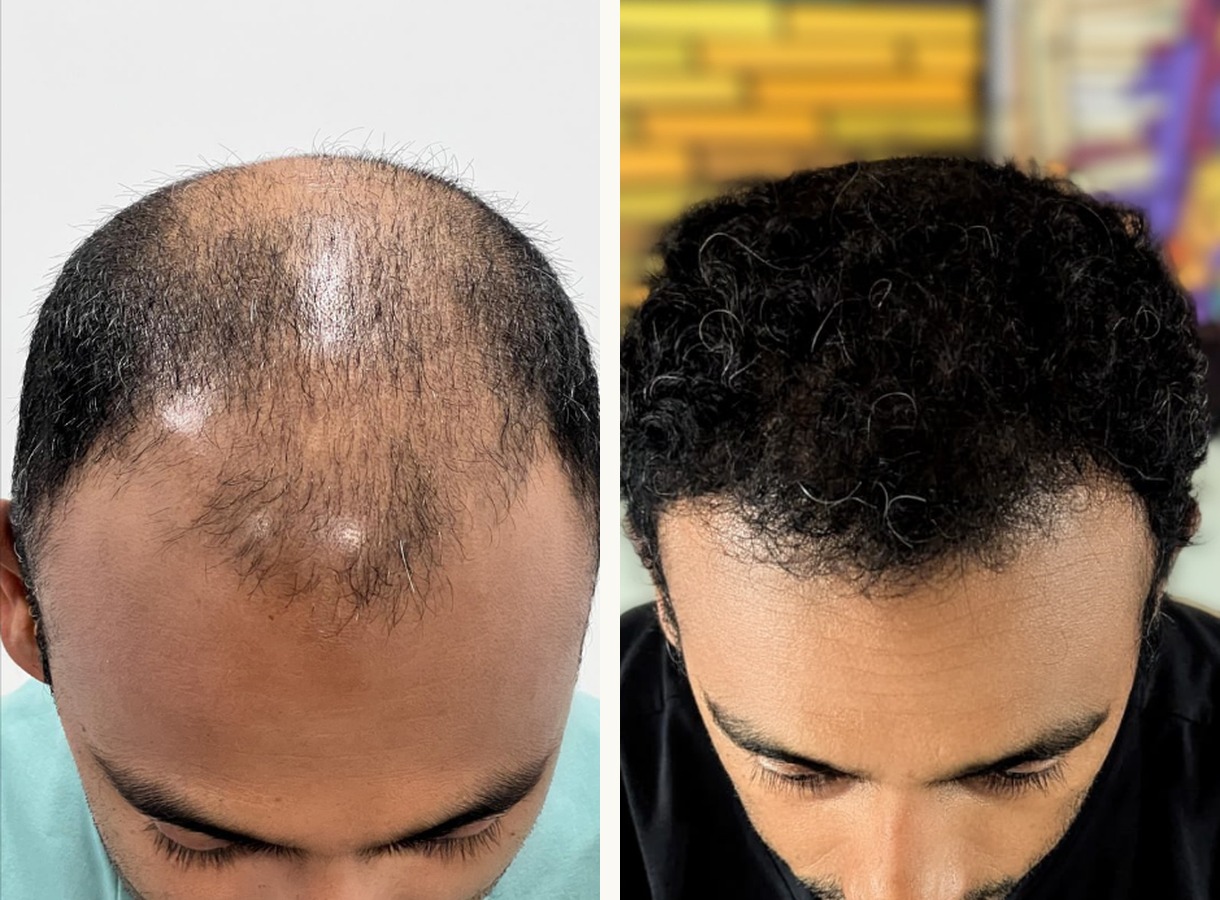 Crown and mid-scalp hair transplant before and after — Top-down view