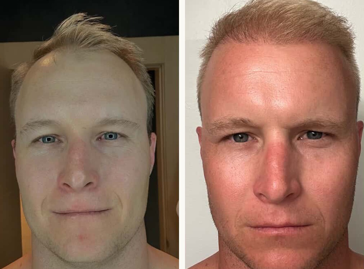 Hairline restoration hair transplant before and after — Front view
