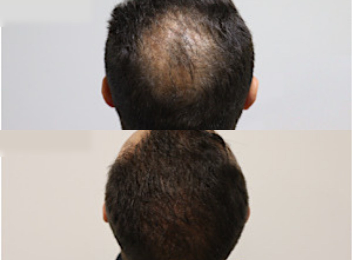 Crown hair transplant before and after — Back view