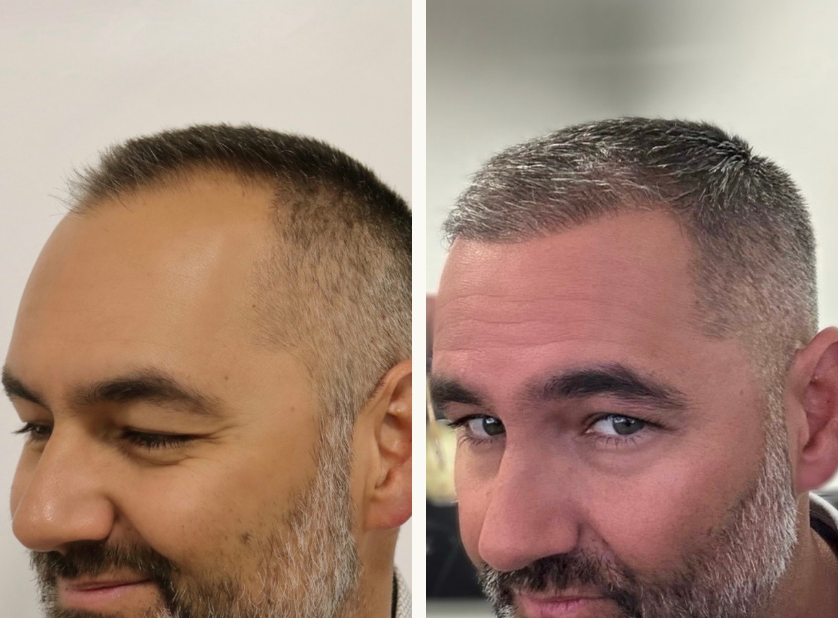 Hairline and temples hair transplant before and after — Three-quarter view