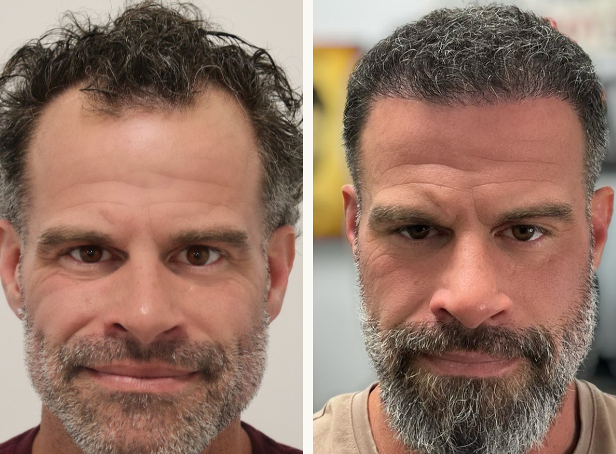 Hairline and mid-scalp hair transplant before and after — Front view