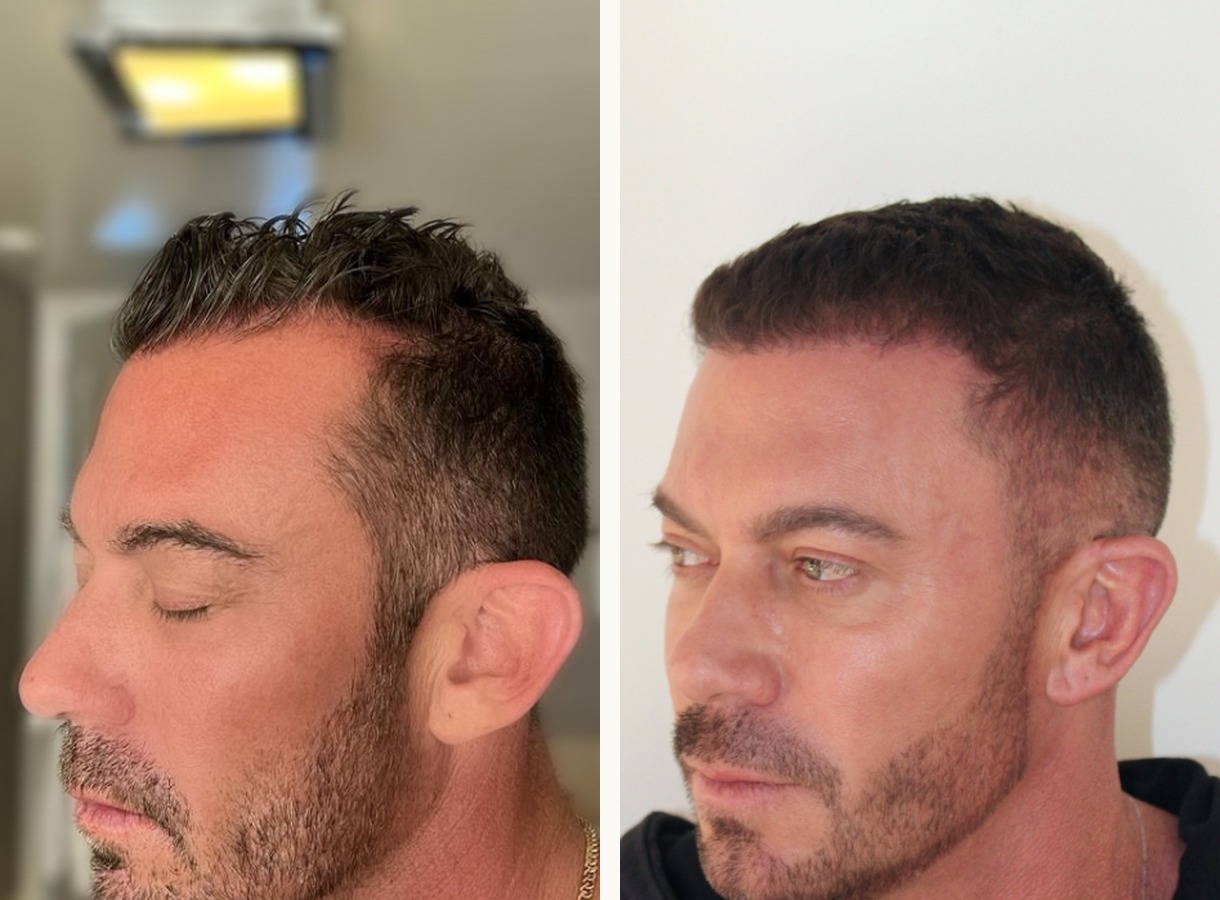 Hairline restoration hair transplant before and after — Three-quarter view