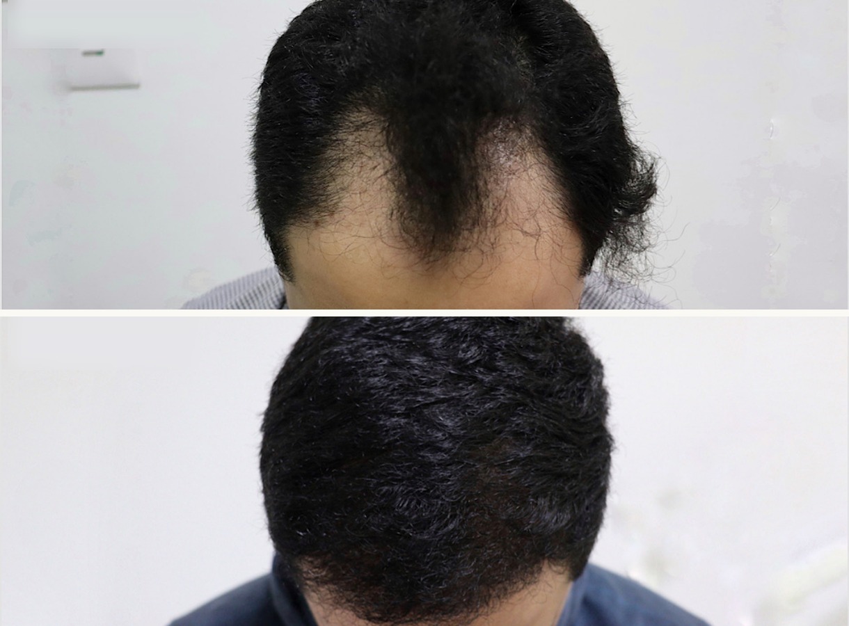 Hairline and mid-scalp hair transplant before and after — Top-down view