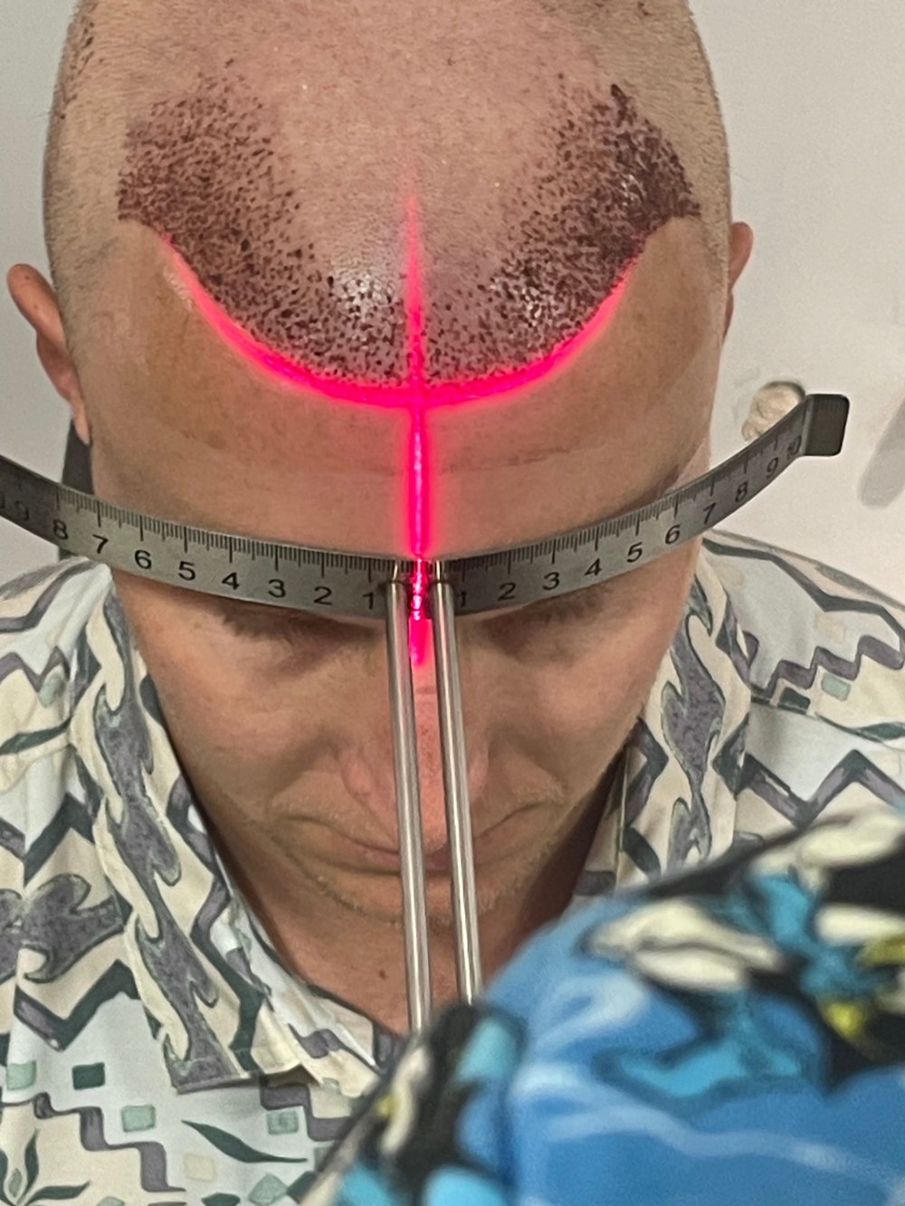 Encore surgeon mapping a hairline with a laser level and caliper for precise symmetry