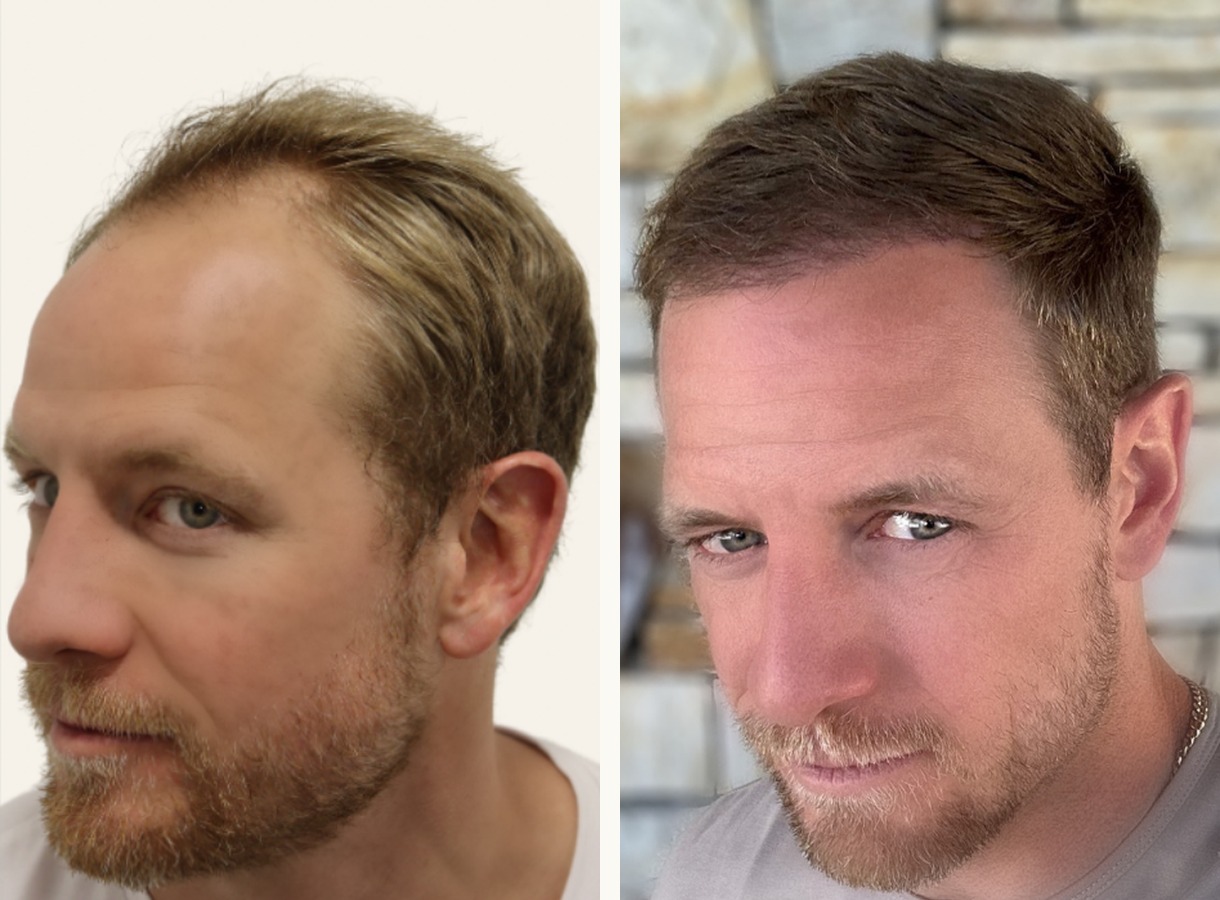 Hairline and temples hair transplant before and after — Front view