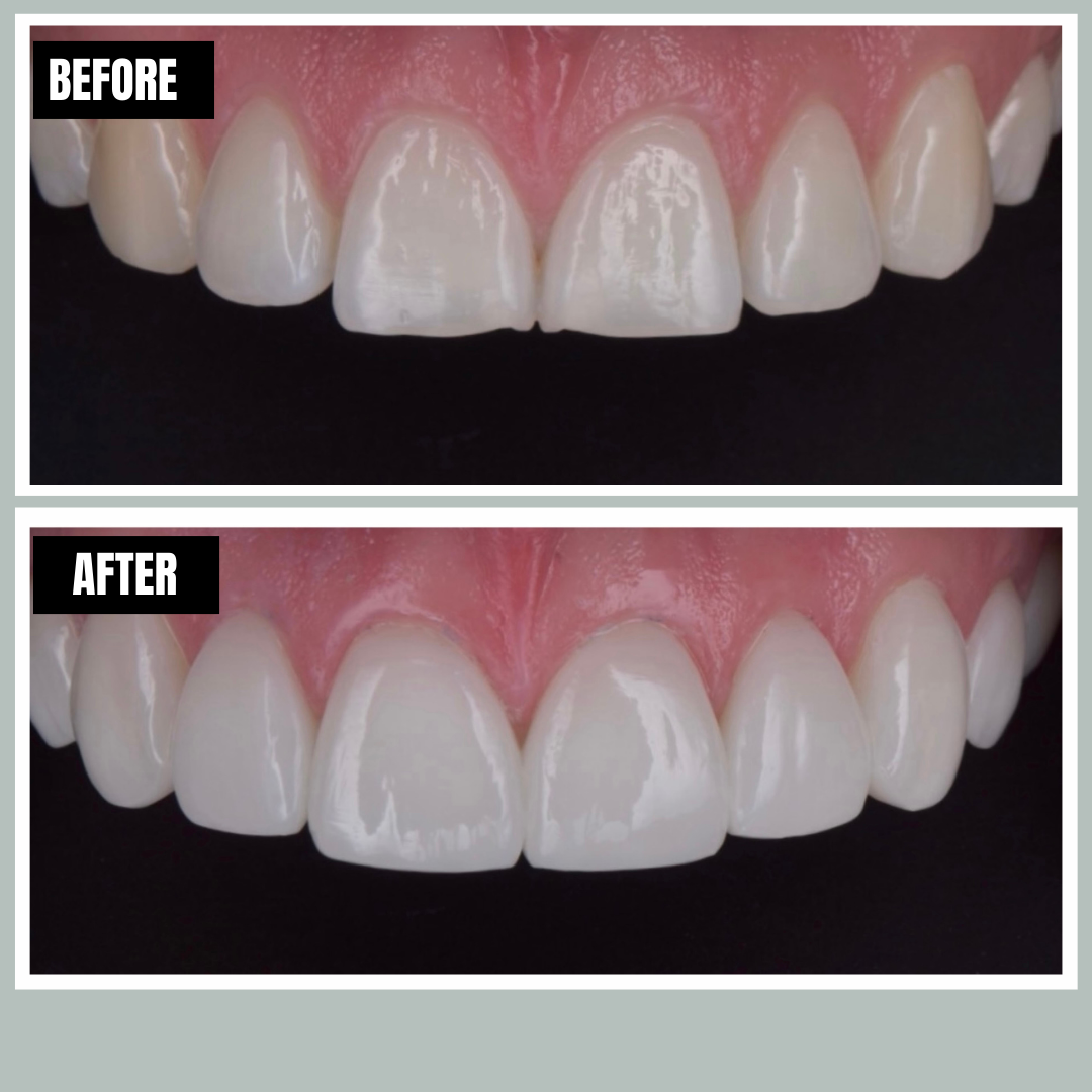 Veneers before and after, Encore Bogotá patient