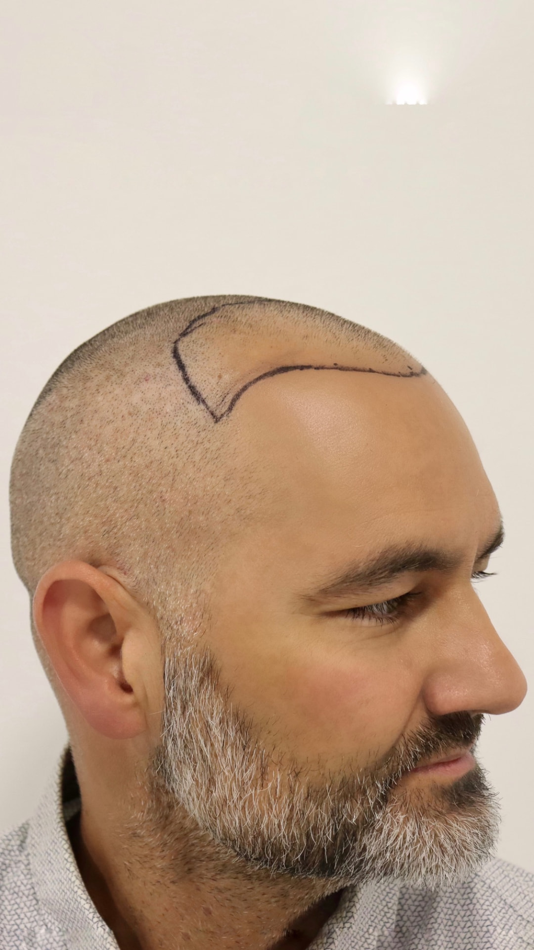 Hairline design drawn in ink on a buzzed scalp before extraction begins