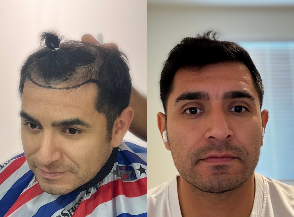 Hairline restoration hair transplant before and after — Front view