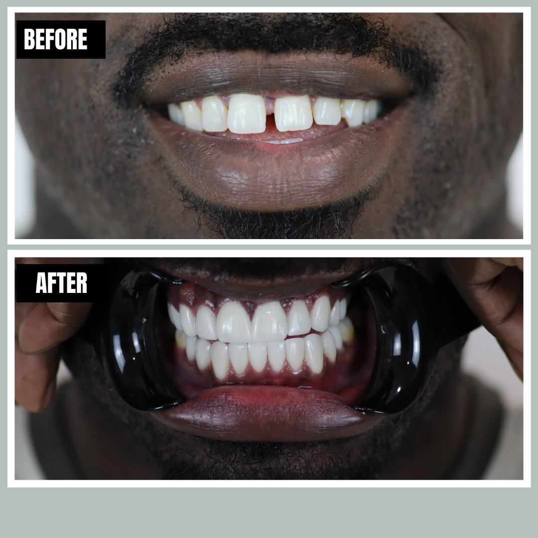 Veneers before and after, Encore Bogotá patient