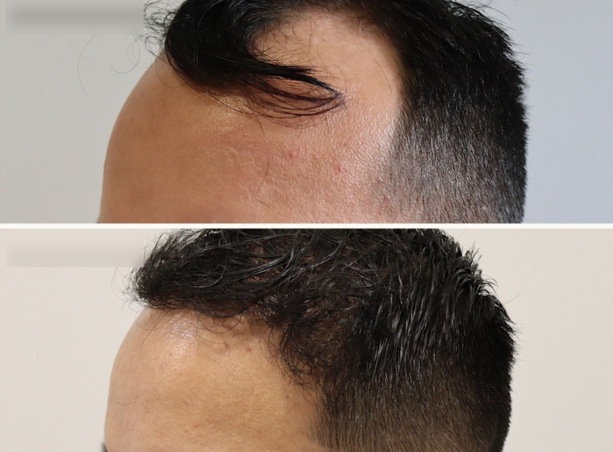 Hairline and temples hair transplant before and after — Top-down view