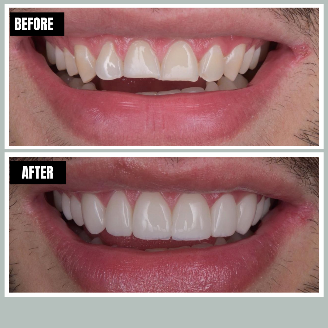 Veneers before and after, Encore Bogotá patient