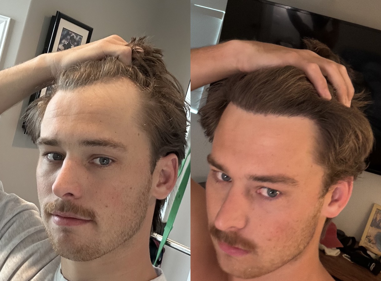 Hairline restoration hair transplant before and after — Three-quarter view