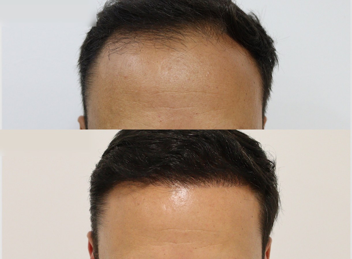 Hairline restoration hair transplant before and after — Front view
