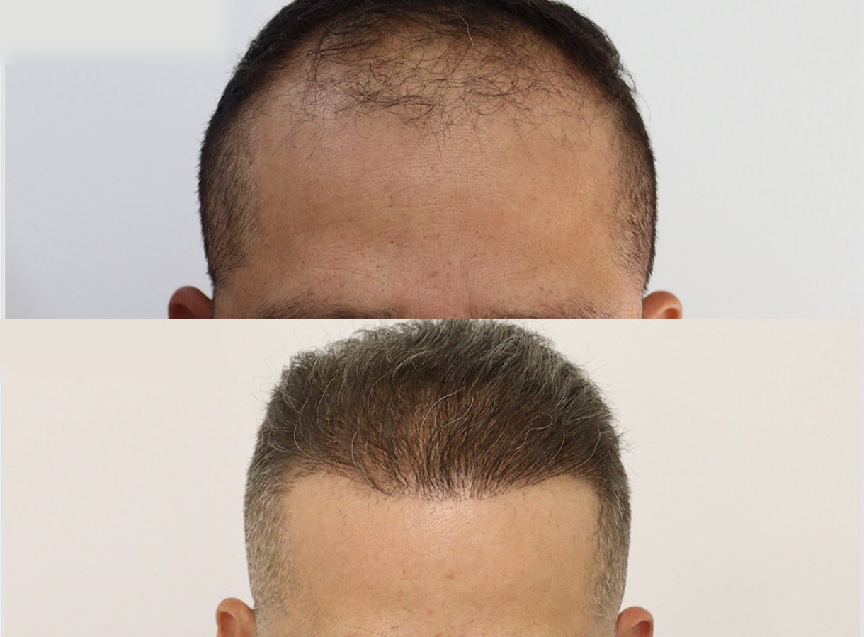 Hairline and mid-scalp hair transplant before and after — Front view
