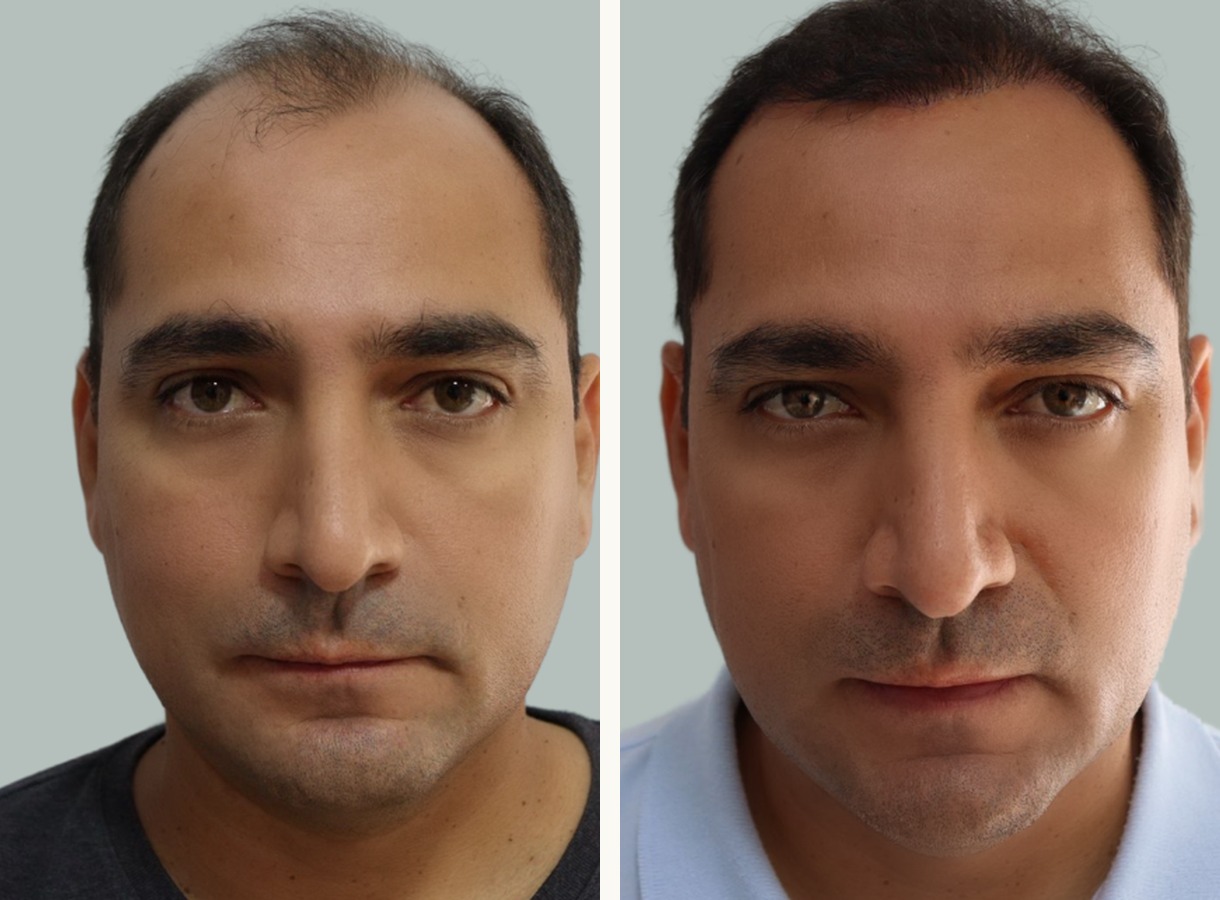 Hairline and mid-scalp hair transplant before and after — Front view