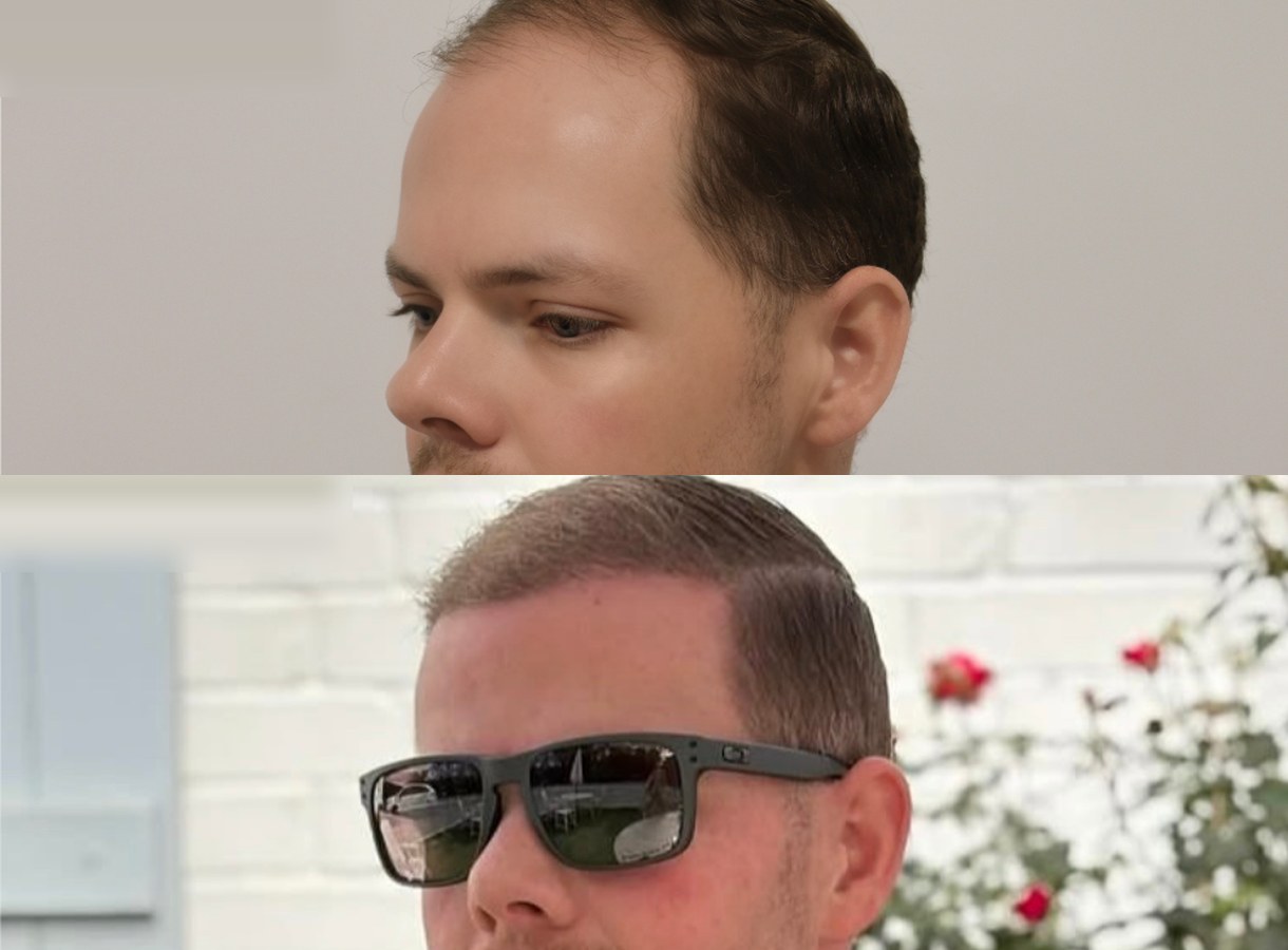 Hairline and temples hair transplant before and after — Side profile view