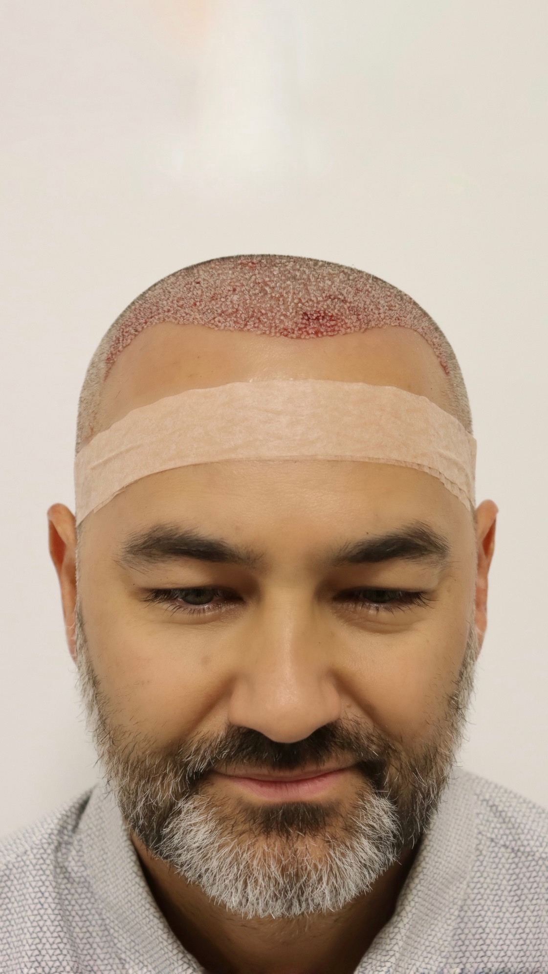 Freshly implanted grafts immediately after the FUE procedure