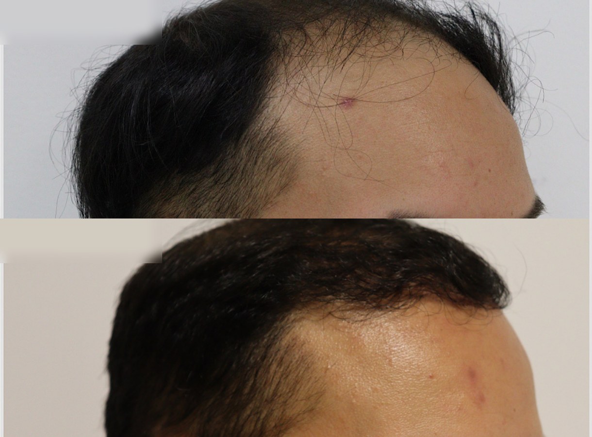 Hairline and temples hair transplant before and after — Three-quarter view